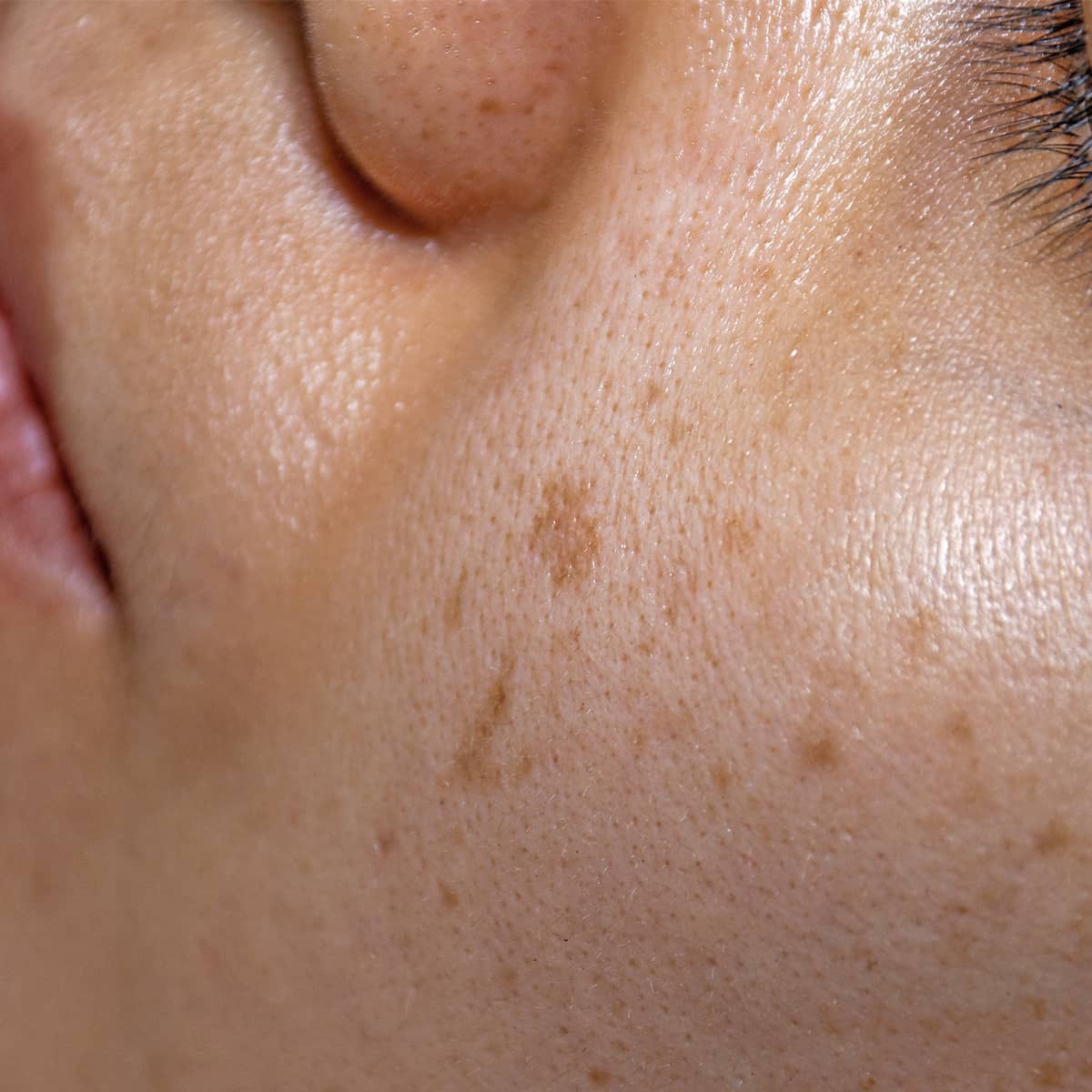 Post-Inflammatory Hyperpigmentation (PIH) on the Skin