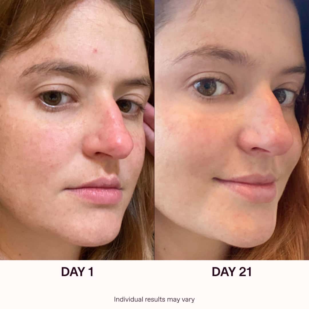 Red Light Therapy Before and After | SolaWave