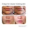 Two sets of before-and-after images show skin improvement. Top: Facial skin close-up with Bye Acne Pro Kit by SolaWave improving acne from Day 1 to smoother Day 3. Bottom: Lips and chin clearer by Day 3. Text: 3 days for clearer-looking skin with SolaWave.