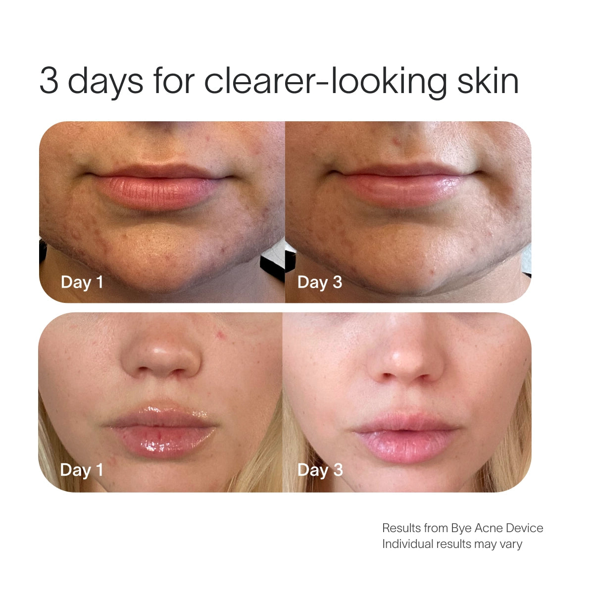 Two sets of before-and-after images show skin improvement. Top: Facial skin close-up with Bye Acne Pro Kit by SolaWave improving acne from Day 1 to smoother Day 3. Bottom: Lips and chin clearer by Day 3. Text: 3 days for clearer-looking skin with SolaWave.