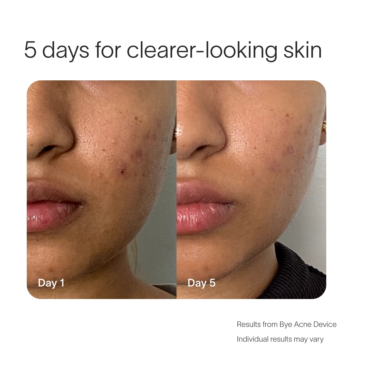 Side-by-side comparison of cheek and jaw on Day 1 and Day 5, showing reduced acne. Text reads, Achieve clearer skin in 5 days using SolaWaves Bye Acne Pro Kit with light therapy. Individual results may vary.