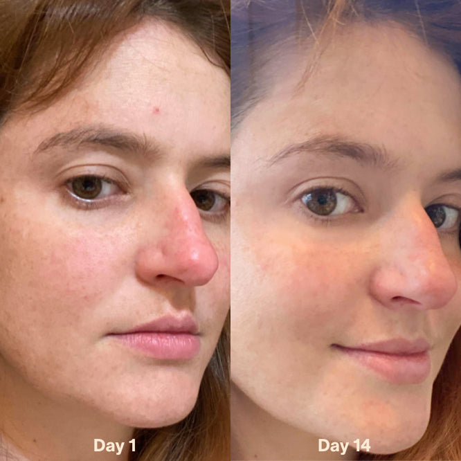 red light therapy ezcema before after