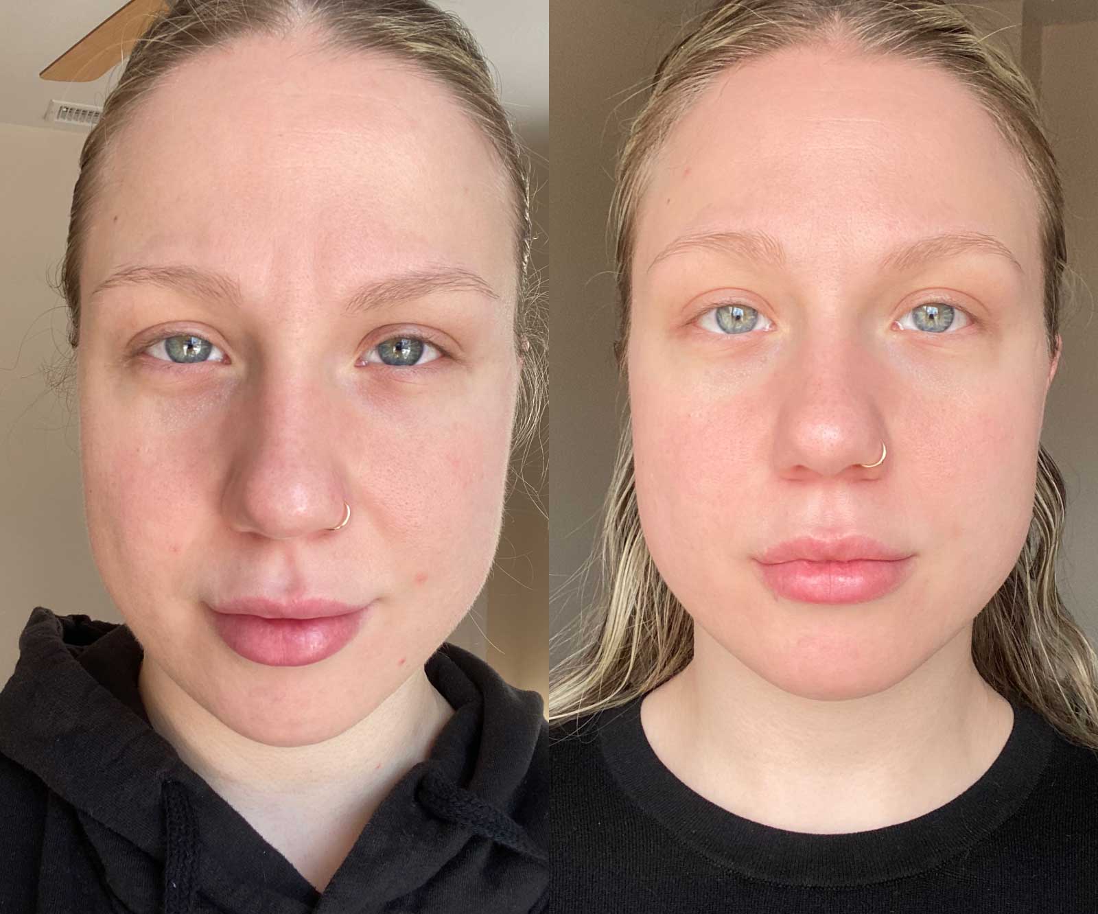 Before and After 14 Days - Skincare Tools - Solawave Wand Red Light Therapy Microcurrent Therapeutic Warmth and Facial Massage