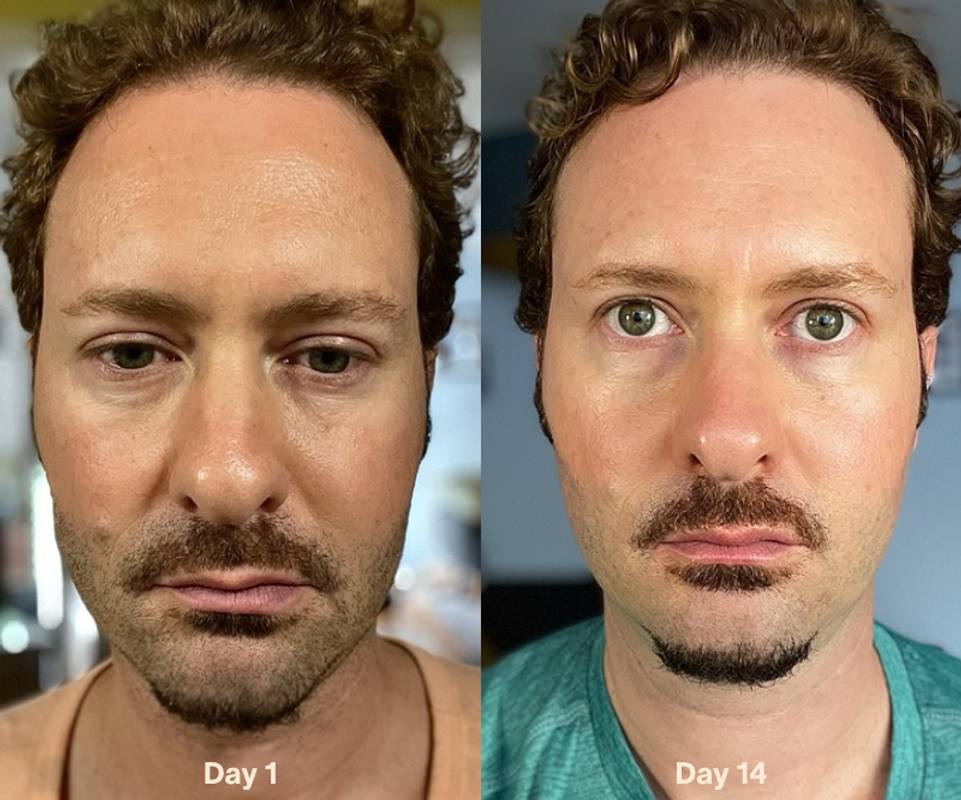 red light therapy men before after collagen