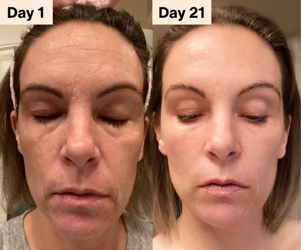 red light therapy microcurrent for 11s jawline forehead lines under eye bags
