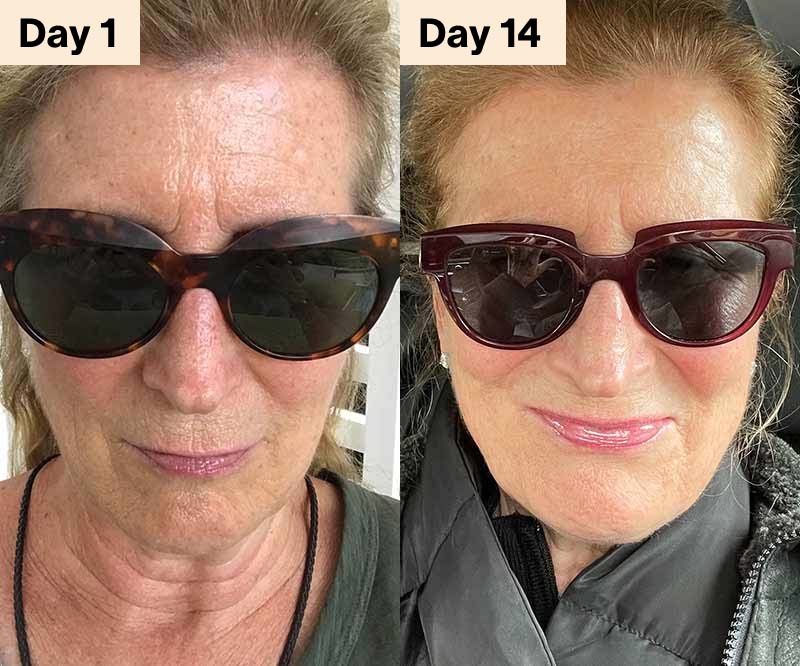 Red Light Therapy Before and After for Wrinkles Fine lines 11s Puffiness Dark Circles Turkey Neck Droopy Skin Crepey Skin Eye Bags Under-Eye Bags De-Puffing