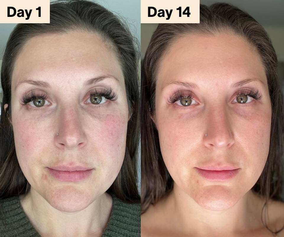 red light therapy ezcema before after