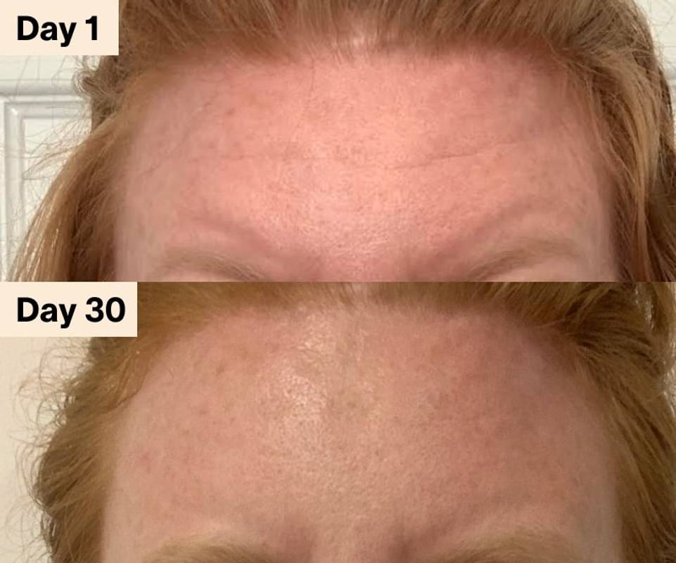 Forehead Wrinkles Fine Lines Before and After Solawave Red Light Therapy Microcurrent Gua Sha
