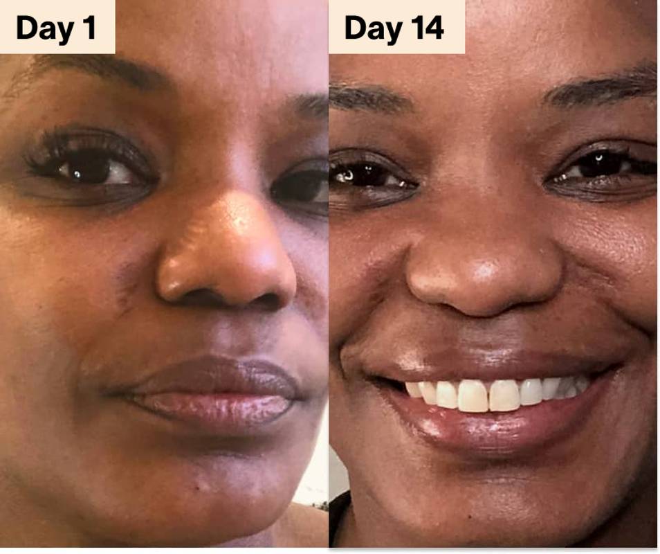 acne led ljusterapi före och efter