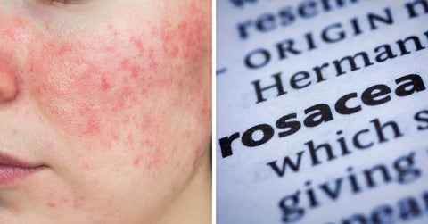 rosacea red light therapy