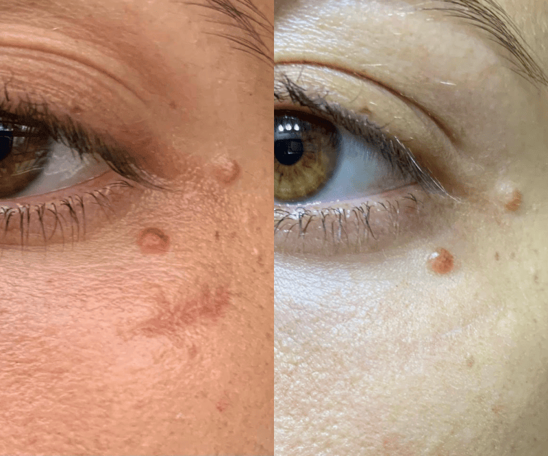 Före och efter 14 dagar - Hudvårdsverktyg - Solawave Wand Rödljusterapi Mikroström Terapeutisk värme och ansiktsmassage för ärr