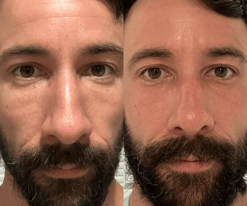 Før og etter 14 dager - Hudpleieverktøy - Solawave Wand Rødlysterapi Mikrostrøm Terapeutisk varme og ansiktsmassasje