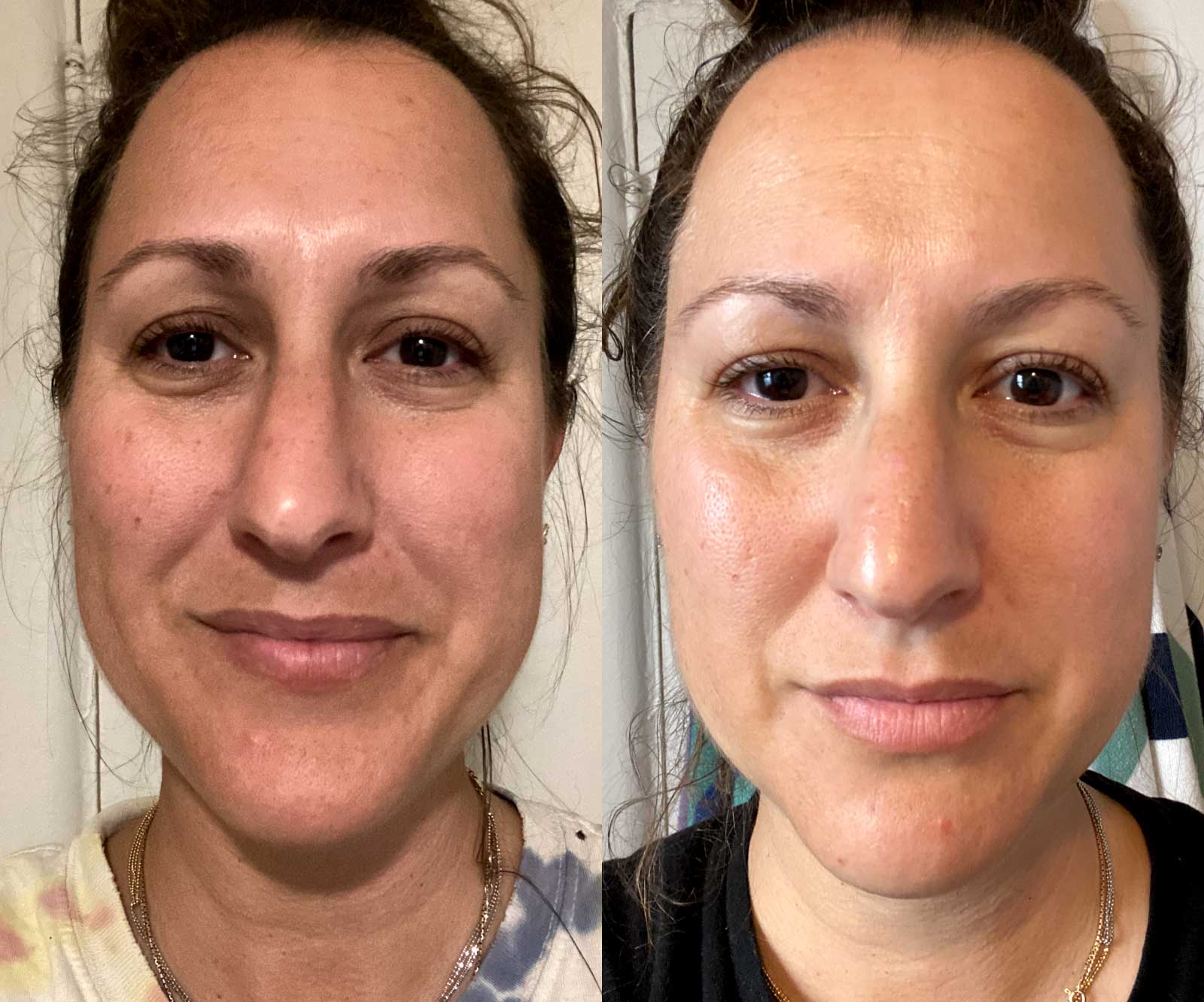 Før og etter 14 dager - Hudpleieverktøy - Solawave Wand Rødlysterapi Mikrostrøm Terapeutisk varme og ansiktsmassasje