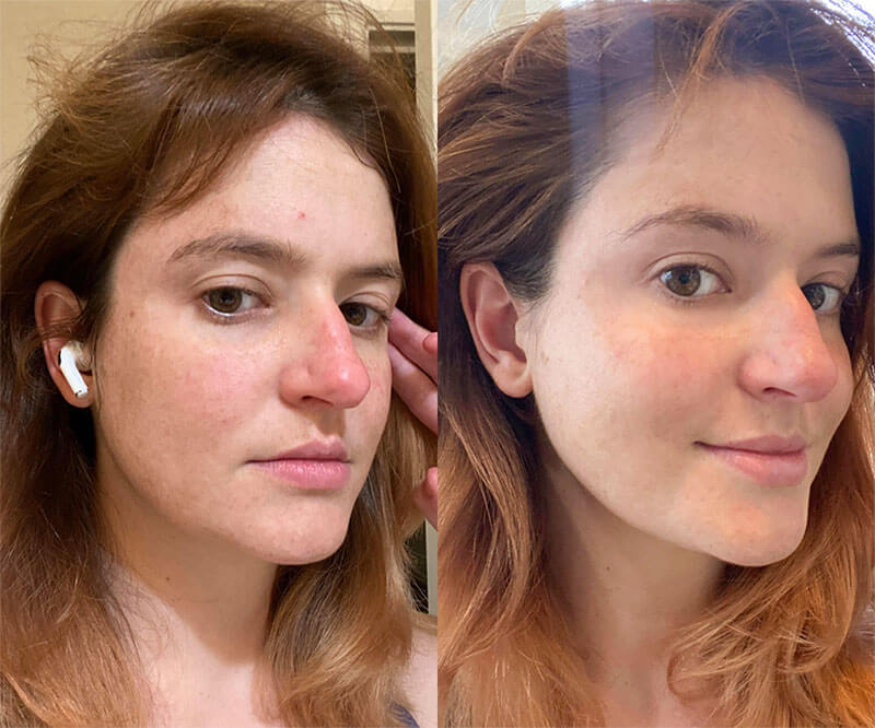 Før og etter 14 dager - Hudpleieverktøy - Solawave Wand Rødlysterapi Mikrostrøm Terapeutisk varme og ansiktsmassasje Hudakne